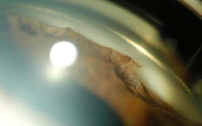 Synéchie dans un ICE syndrome