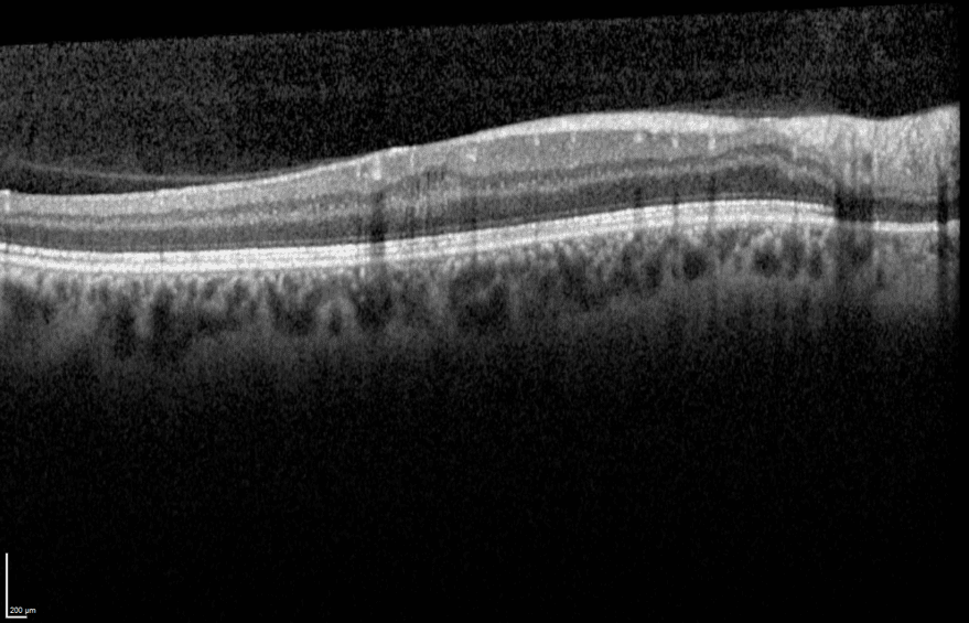 Image OCT montrant la structure du nerf optique.