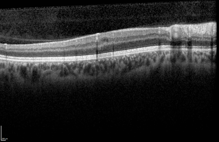 Image OCT montrant le nerf optique et la rétine.