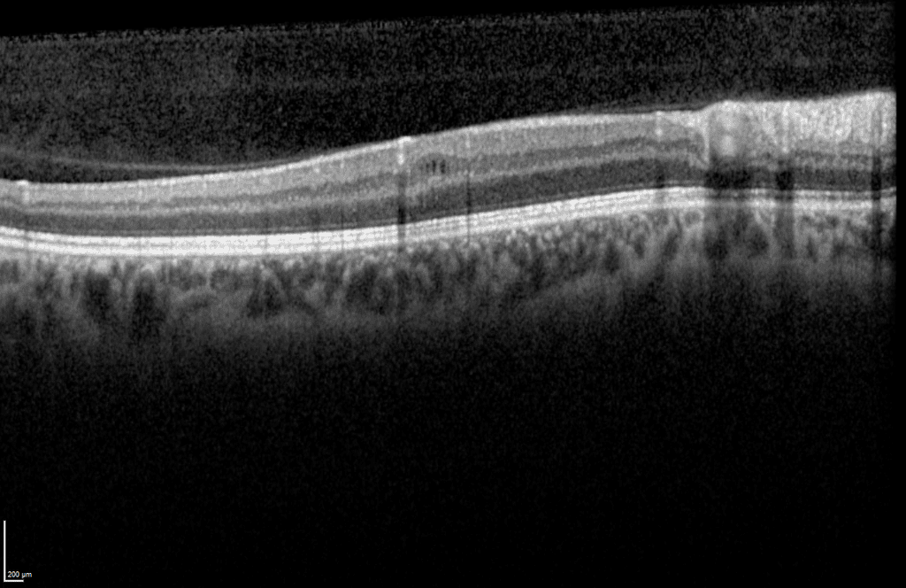 Image en noir et blanc d'une coupe de la rétine.